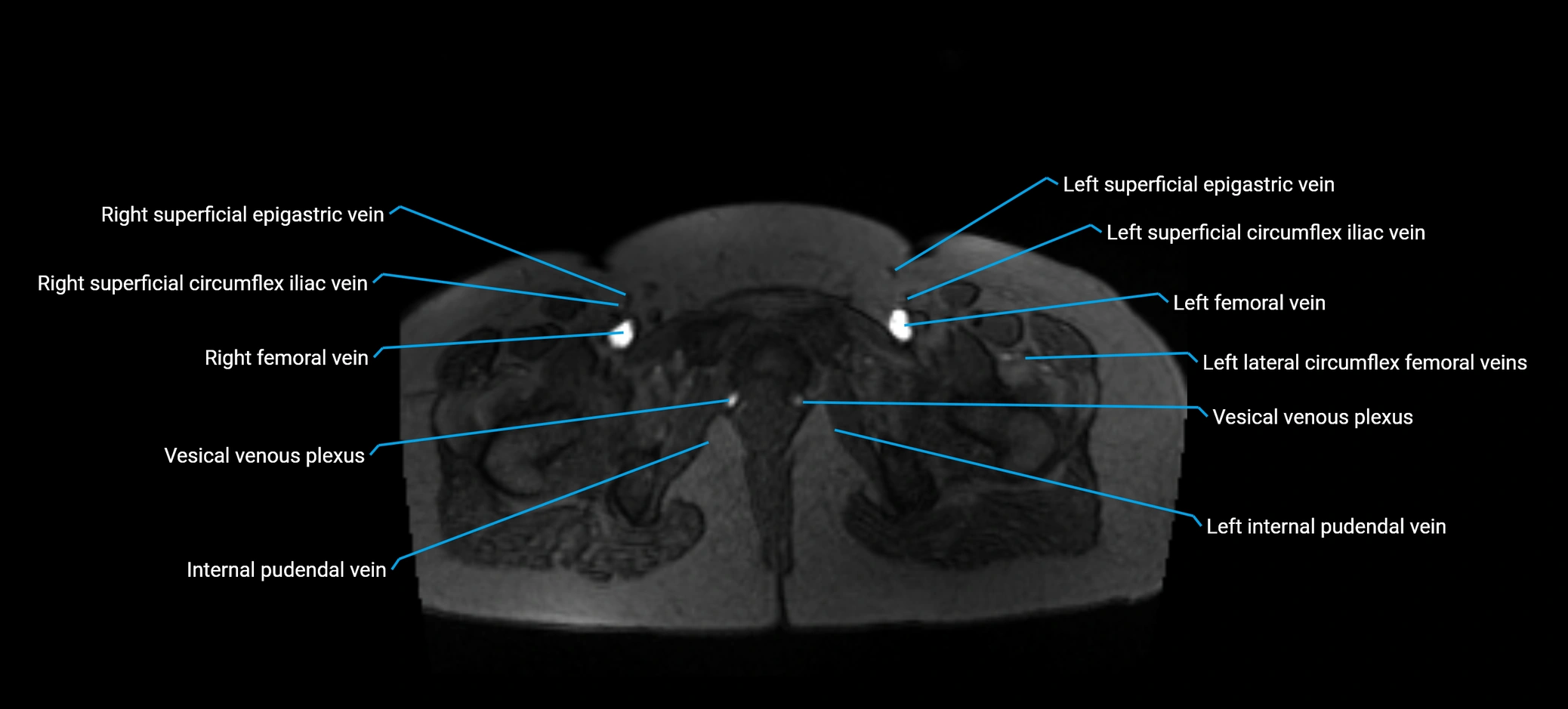 MRV abdomen pelvis & lower limb axial cross sectional anatomy labelled MRI image 191 (1).webp